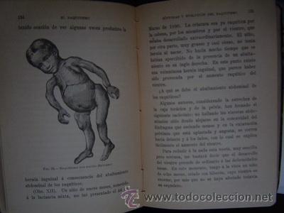 Libros antiguos: 1895 EL RAQUITISMO J. COMBY MUY RARO - Foto 3