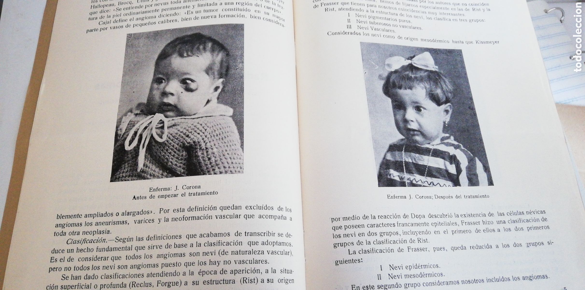 Libros antiguos: RADIUMTERAPIA DE LOS ANGIOMAS