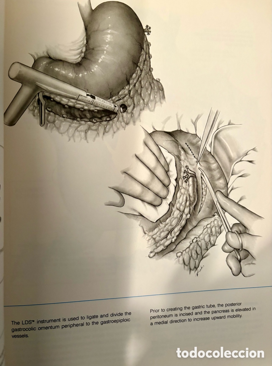 Libros: Stapling Techniques General Surgery 1988 - Foto 5