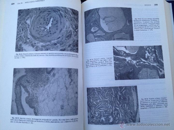 Libros de segunda mano: OTORRINOLARINGOLOGIA PEDI&Aacute;TRICA (SAMUEL LEVY) - Foto 3