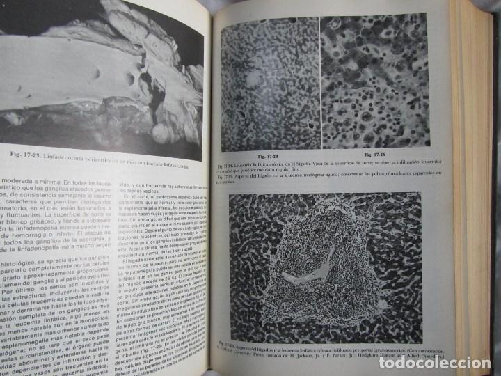 Libros de segunda mano: Patolog&iacute;a estructural y funcional Robbins 1975 - Foto 13