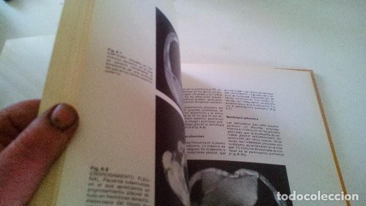 Libros de segunda mano: TOMOGRAFIA COMPUTARIZADA EN EL TORAX- A. manchon grimalt-1982 - Foto 5