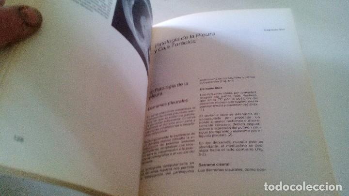 Libros de segunda mano: TOMOGRAFIA COMPUTARIZADA EN EL TORAX- A. manchon grimalt-1982 - Foto 6
