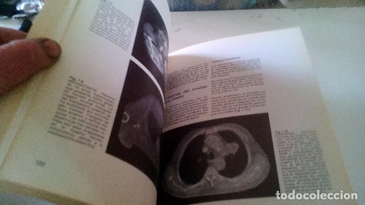 Libros de segunda mano: TOMOGRAFIA COMPUTARIZADA EN EL TORAX- A. manchon grimalt-1982 - Foto 7