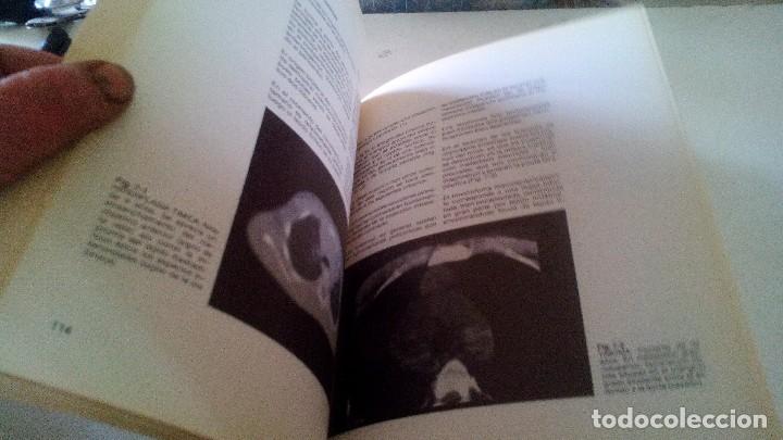 Libros de segunda mano: TOMOGRAFIA COMPUTARIZADA EN EL TORAX- A. manchon grimalt-1982 - Foto 8