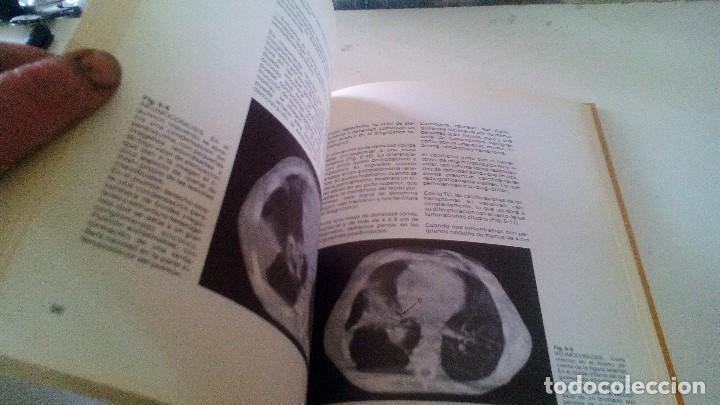 Libros de segunda mano: TOMOGRAFIA COMPUTARIZADA EN EL TORAX- A. manchon grimalt-1982 - Foto 9