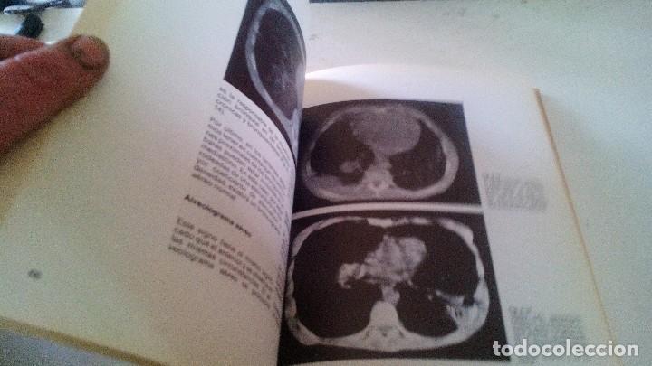 Libros de segunda mano: TOMOGRAFIA COMPUTARIZADA EN EL TORAX- A. manchon grimalt-1982 - Foto 10