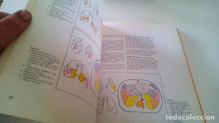 Libros de segunda mano: TOMOGRAFIA COMPUTARIZADA EN EL TORAX- A. manchon grimalt-1982 - Foto 12