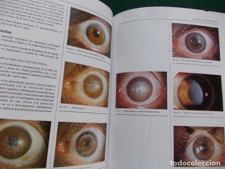 Libros de segunda mano: LIBRO OFTALMOLOGIA QUERATOPLASTIAS Y QUERATOPROTESIS - Foto 2