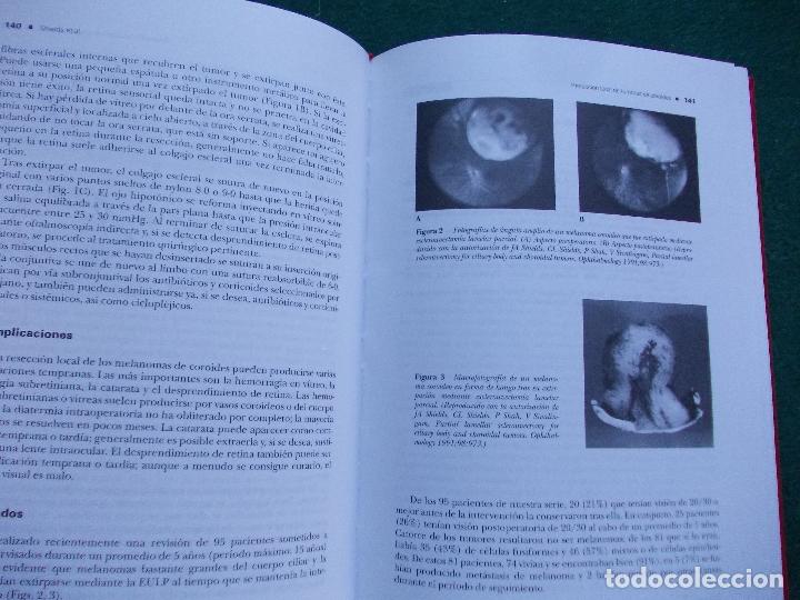 Libros de segunda mano: TUMORES OCULARES MALIGNOS AVANCES - Foto 2