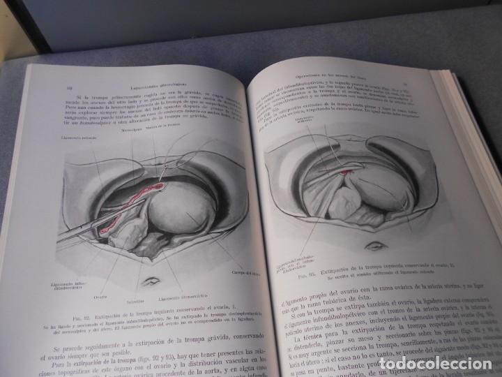 Libros de segunda mano: OPERACIONES GINECOLOGICAS - Foto 5