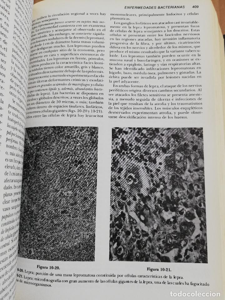 Libros de segunda mano: PATOLOG&Iacute;A ESTRUCTURAL Y FUNCIONAL (DR. STANLEY L. ROBBINS) - Foto 13