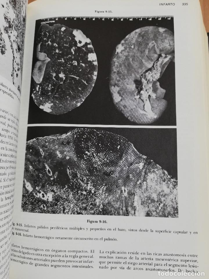 Libros de segunda mano: PATOLOG&Iacute;A ESTRUCTURAL Y FUNCIONAL (DR. STANLEY L. ROBBINS) - Foto 14
