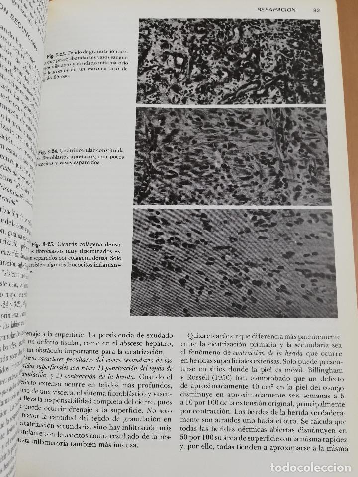 Libros de segunda mano: PATOLOG&Iacute;A ESTRUCTURAL Y FUNCIONAL (DR. STANLEY L. ROBBINS) - Foto 19