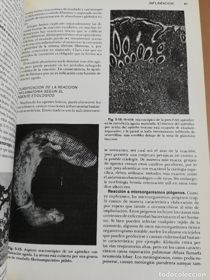 Libros de segunda mano: PATOLOG&Iacute;A ESTRUCTURAL Y FUNCIONAL (DR. STANLEY L. ROBBINS) - Foto 20