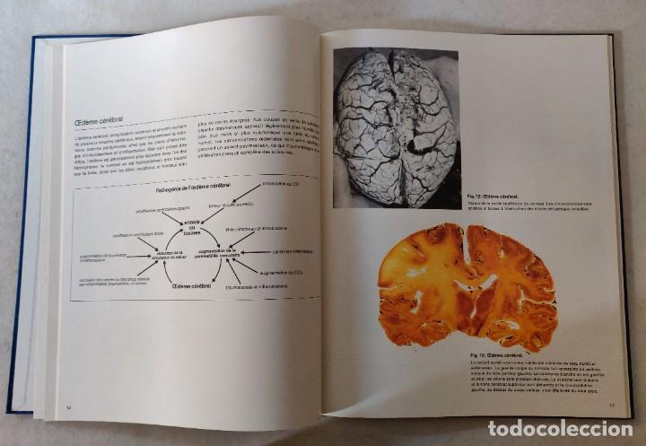 Libros de segunda mano: Libro Atlas DAnatomie Pathologique de LEncephale - Foto 5