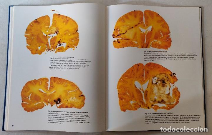 Libros de segunda mano: Libro Atlas DAnatomie Pathologique de LEncephale - Foto 6