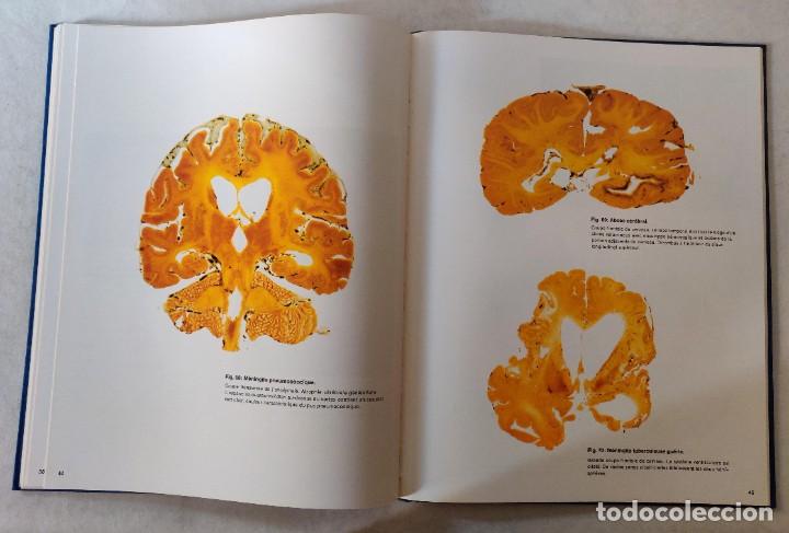 Libros de segunda mano: Libro Atlas DAnatomie Pathologique de LEncephale - Foto 7