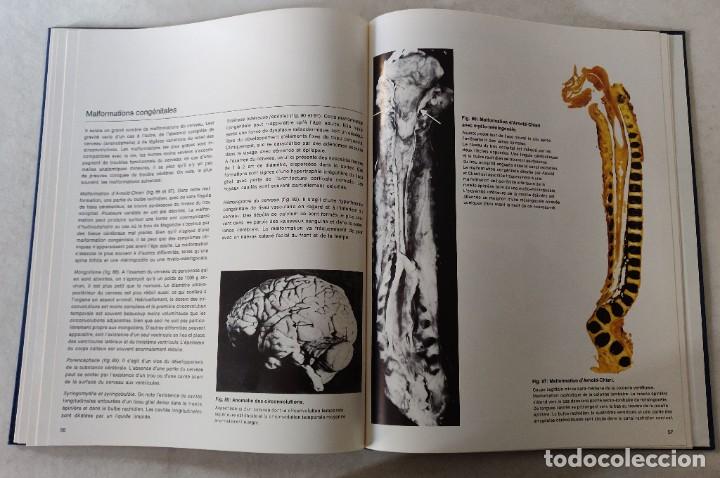 Libros de segunda mano: Libro Atlas DAnatomie Pathologique de LEncephale - Foto 8