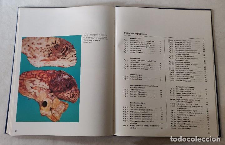 Libros de segunda mano: Libro Atlas DAnatomie Pathologique de LEncephale - Foto 9