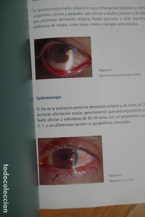 Libros de segunda mano: Conjuntivitis al&eacute;rgicas - Foto 7