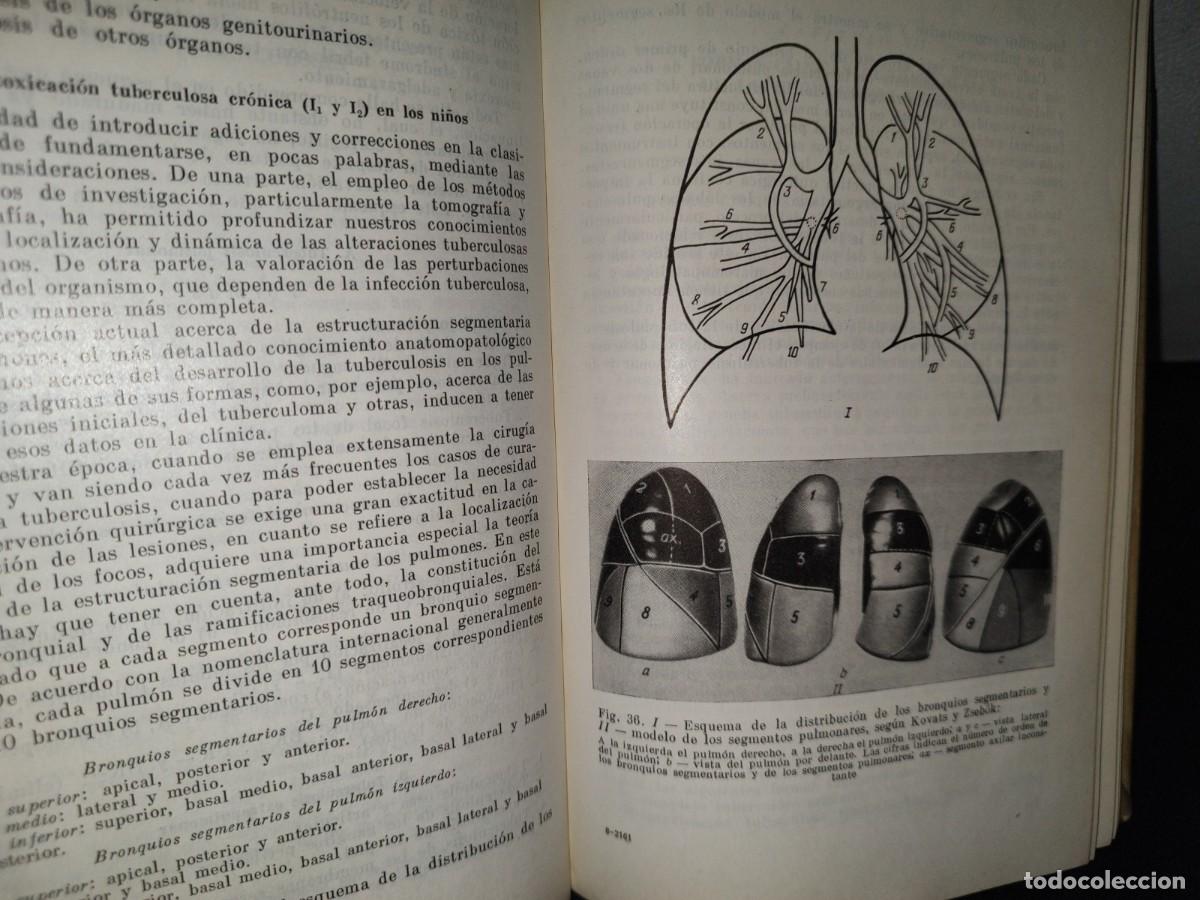 Libros de segunda mano: 9- TUBERCULOSIS - V. EINIS - 70S - Foto 8