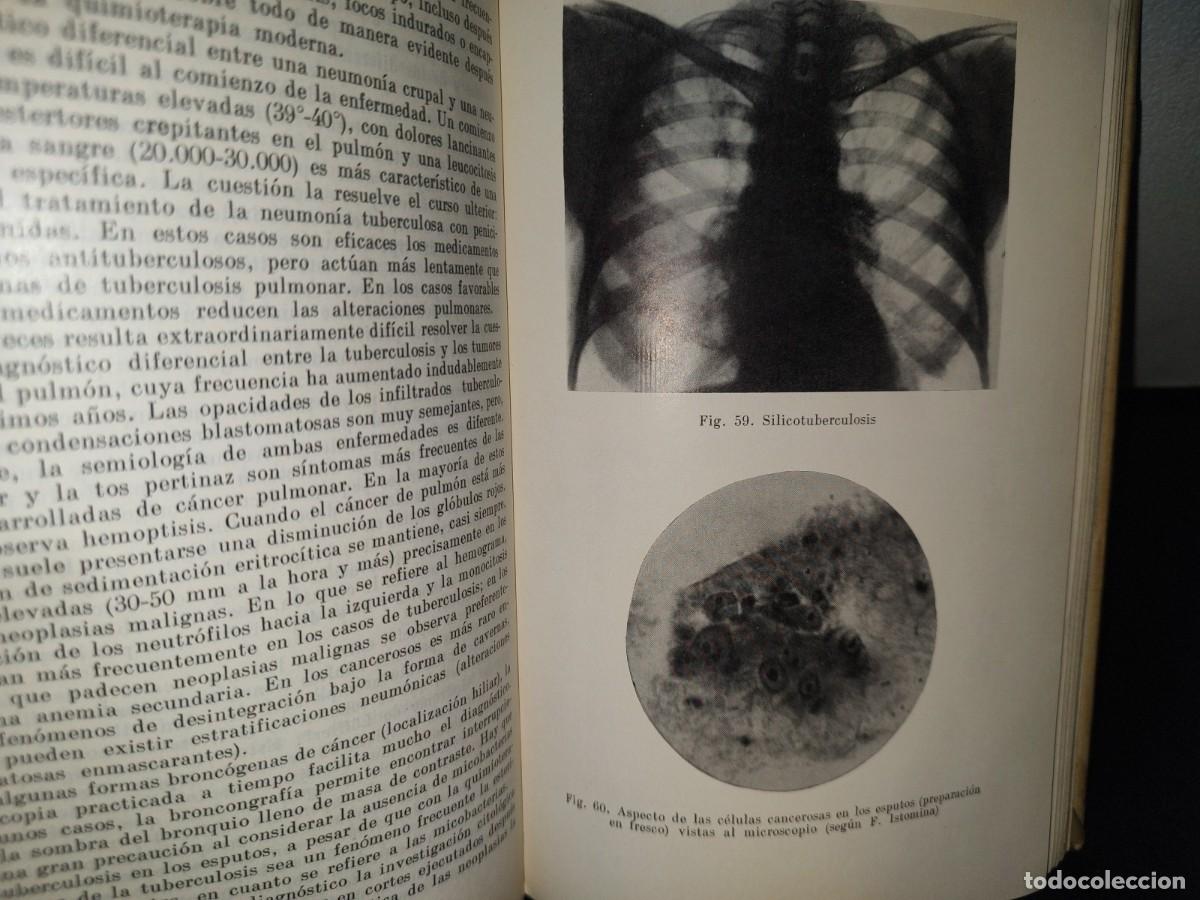 Libros de segunda mano: 9- TUBERCULOSIS - V. EINIS - 70S - Foto 9