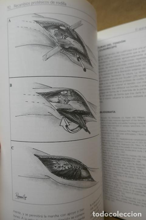 Libros de segunda mano: RECAMBIOS PROT&Eacute;SICOS DE RODILLA. - Foto 10