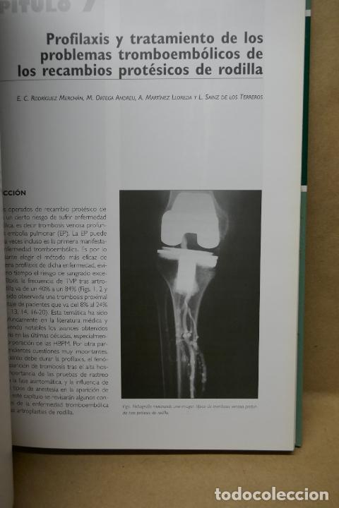 Libros de segunda mano: RECAMBIOS PROT&Eacute;SICOS DE RODILLA. - Foto 12