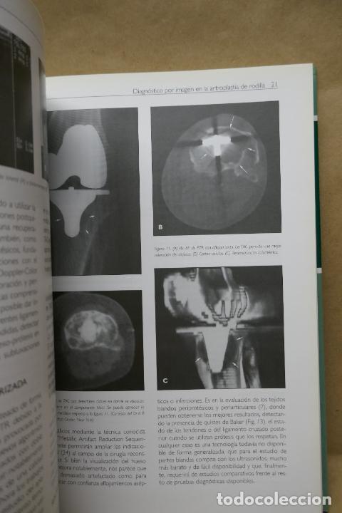 Libros de segunda mano: RECAMBIOS PROT&Eacute;SICOS DE RODILLA. - Foto 14