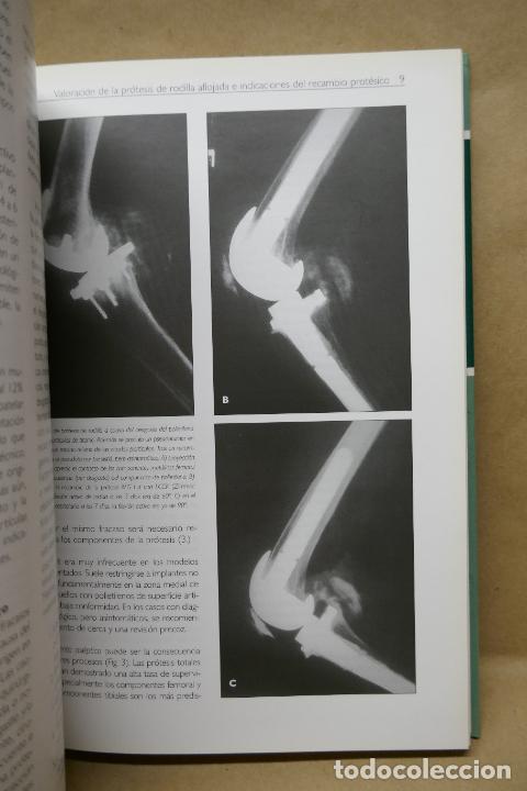 Libros de segunda mano: RECAMBIOS PROT&Eacute;SICOS DE RODILLA. - Foto 15