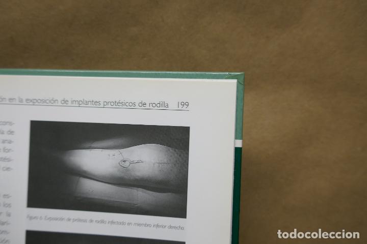 Libros de segunda mano: RECAMBIOS PROT&Eacute;SICOS DE RODILLA. - Foto 16