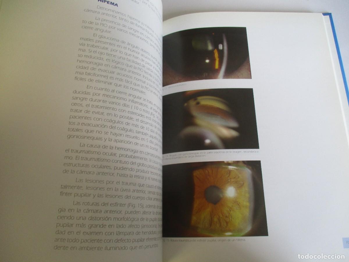Libros de segunda mano: El glaucoma por cierre angular W21999 - Foto 6