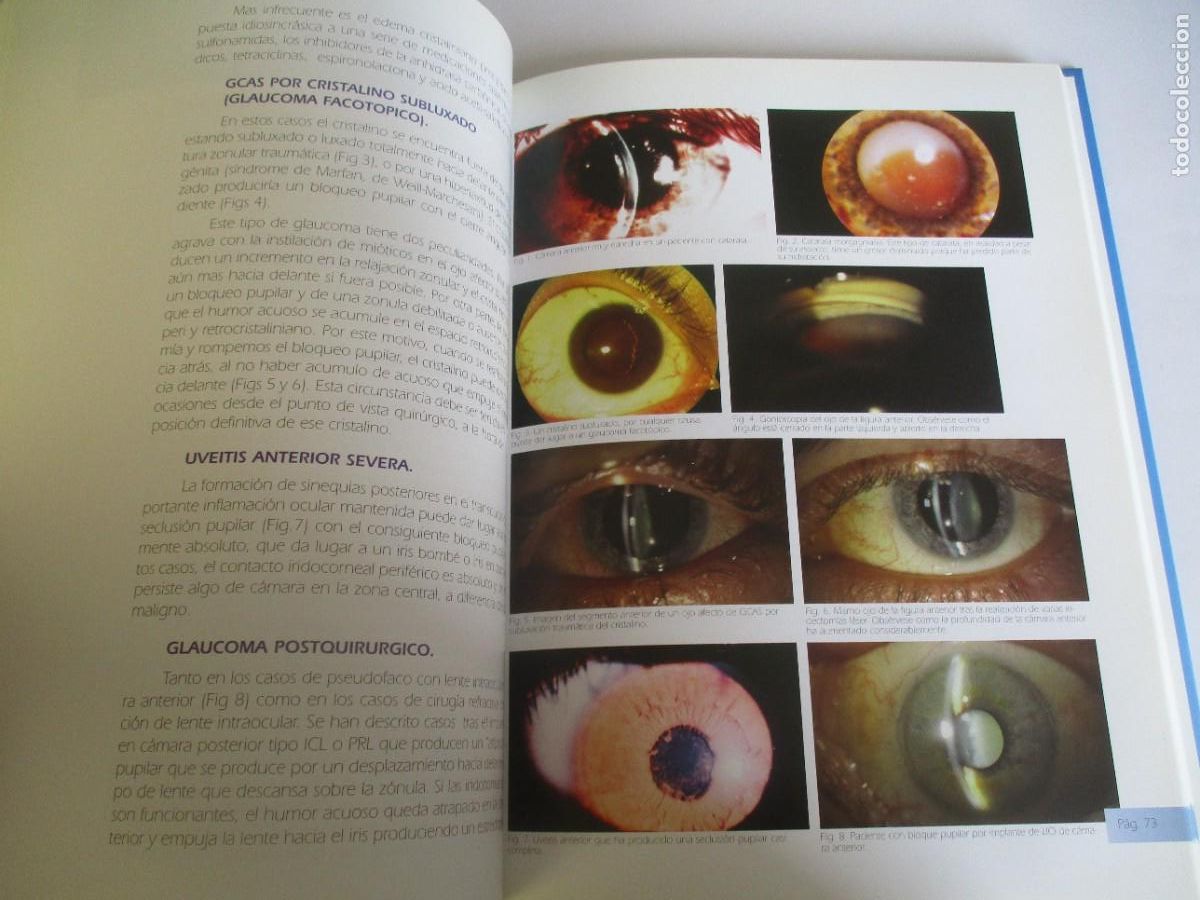 Libros de segunda mano: El glaucoma por cierre angular W21999 - Foto 7
