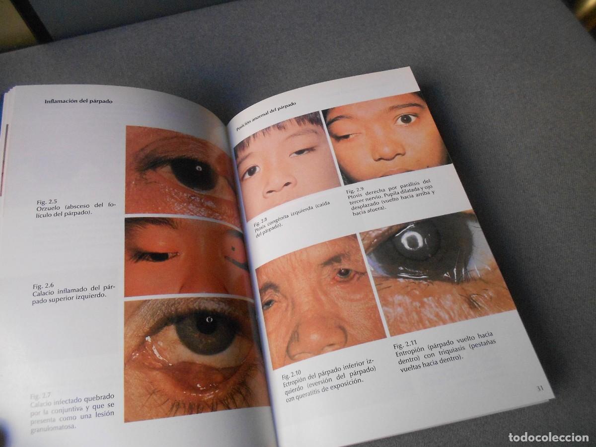 Libros de segunda mano: ATLAS EN COLOR DE OFTALMOLOGIA - Foto 3