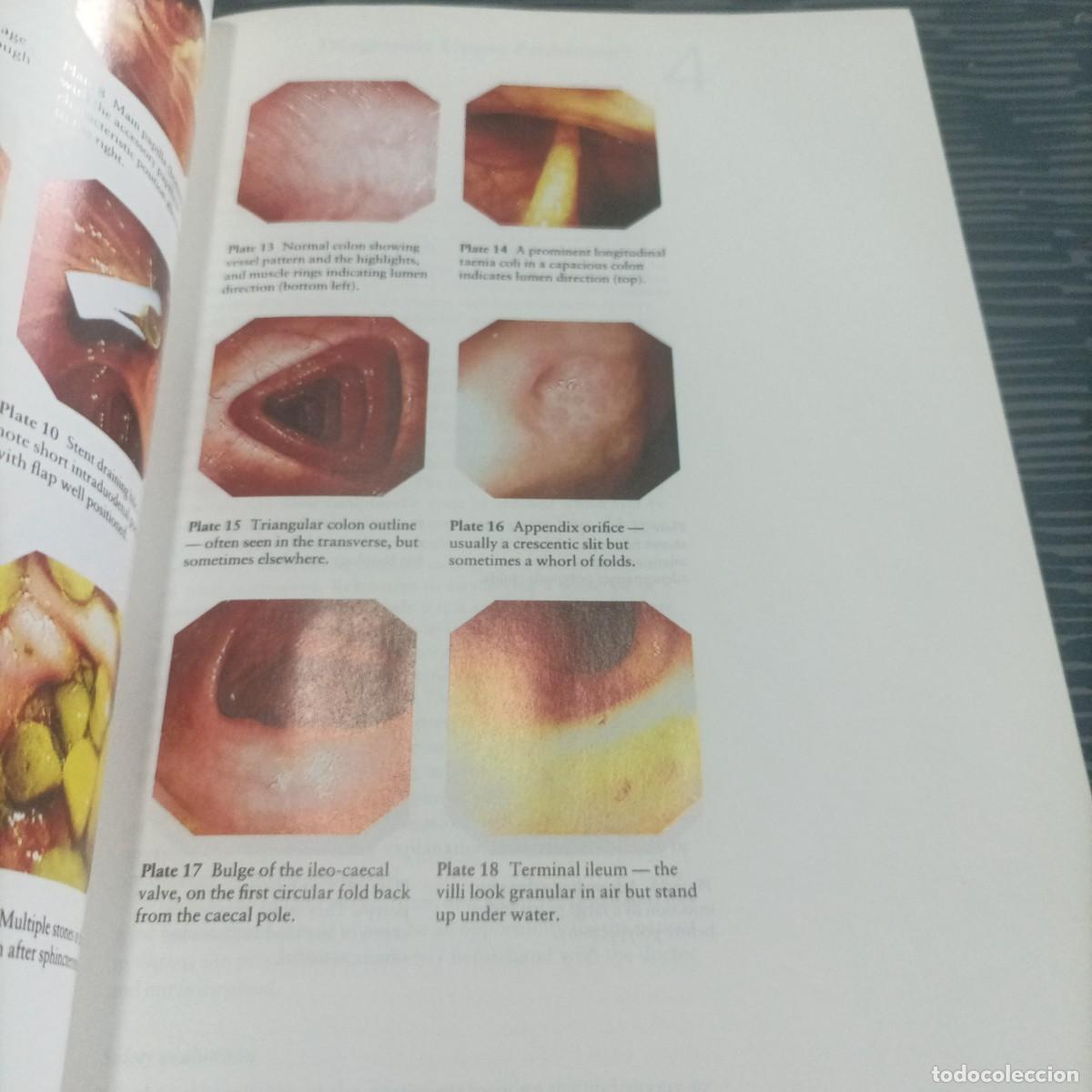 Libros de segunda mano: PRACTICAL GASTROINTESTINAL ENDOSCOPY,PETER B.COTTON,CHRISTOPHER B.WILLIAM,1990,289 PAG. - Foto 4