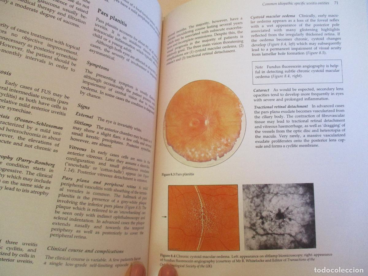 Libros de segunda mano: JACK J. KANSKI Uveitis (ingl&eacute;s) W27489 - Foto 5