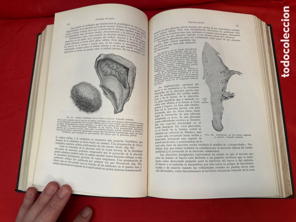 Libros de segunda mano: TRATADO DE OBSTETR&Iacute;CIA - A DODERLEIN 3 VOL&Uacute;MENES, OBRA COMPLETA - Foto 9