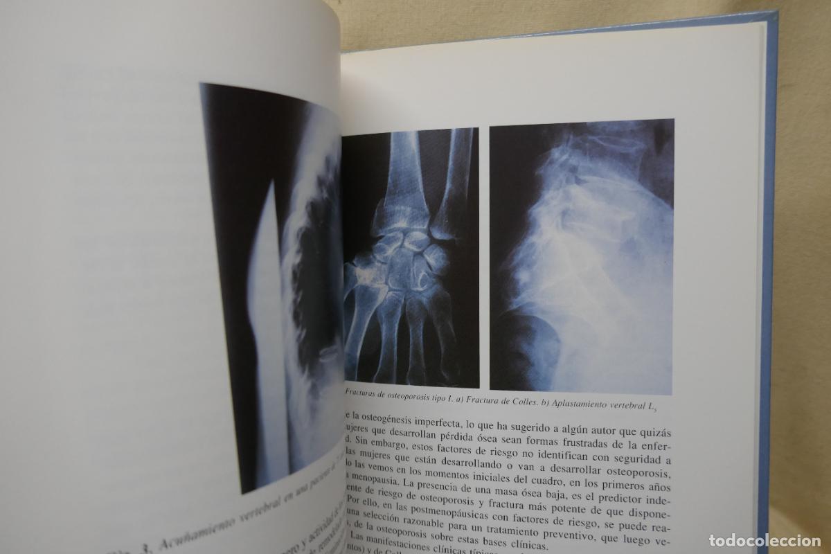 Libros de segunda mano: OSTEOPOROSIS - A DIEZ PEREZ - Foto 13