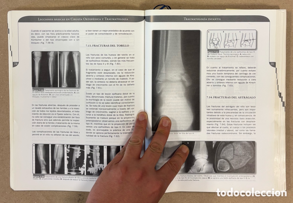 Libros de segunda mano: LECCIONES B&Aacute;SICAS EN CIRUG&Iacute;A ORTOP&Eacute;DICA Y TRAUMATOLOG&Iacute;A. IGNACIO PROUBASTA EDITOR. - Foto 5