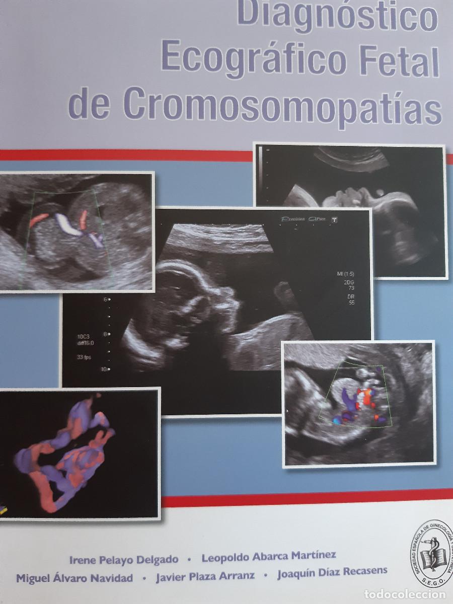 Libros de segunda mano: DIAGNOSTICO ECOGRAFICO FETAL DE CROMOSOMOPATIAS Irene Pelayo Delgado 2012 sistemas medico Toshiba M5