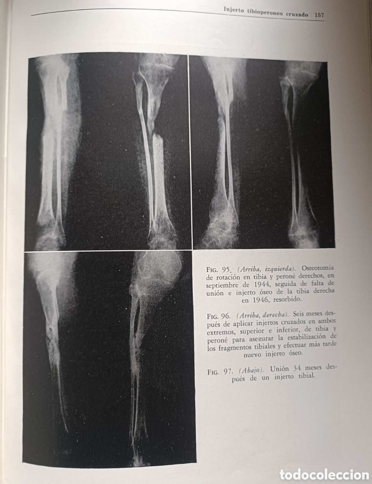 Libros de segunda mano: Libro Ortopedia Pedi&aacute;trica y General - Foto 11