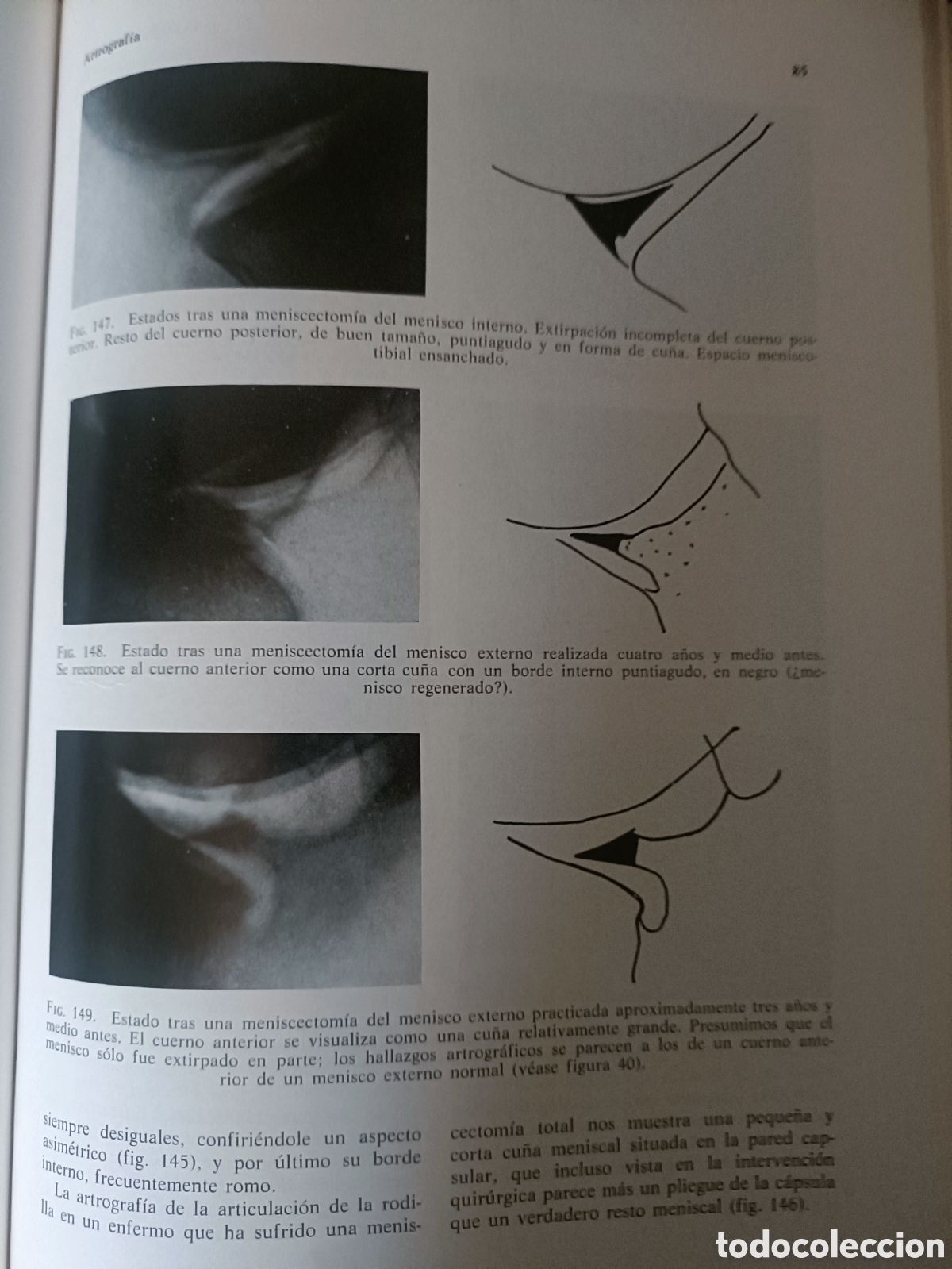 Libros de segunda mano: Libro Lesiones Meniscales P. Ricklin - Foto 3