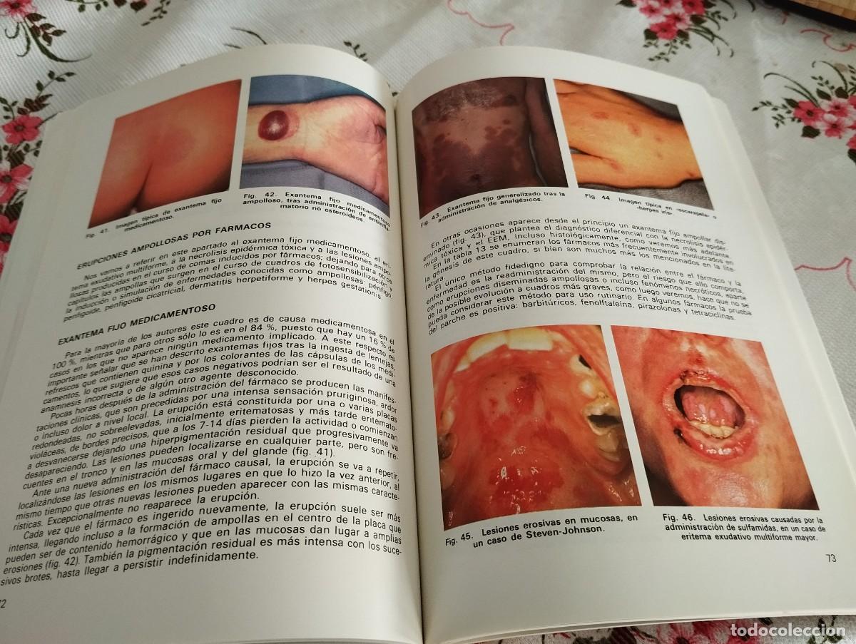 Libri di seconda mano: ERUPCIONES CUTANEAS POR F&Aacute;RMACOS J. F. FRIAS INIESTA Y T. POZO ROMAN 1985