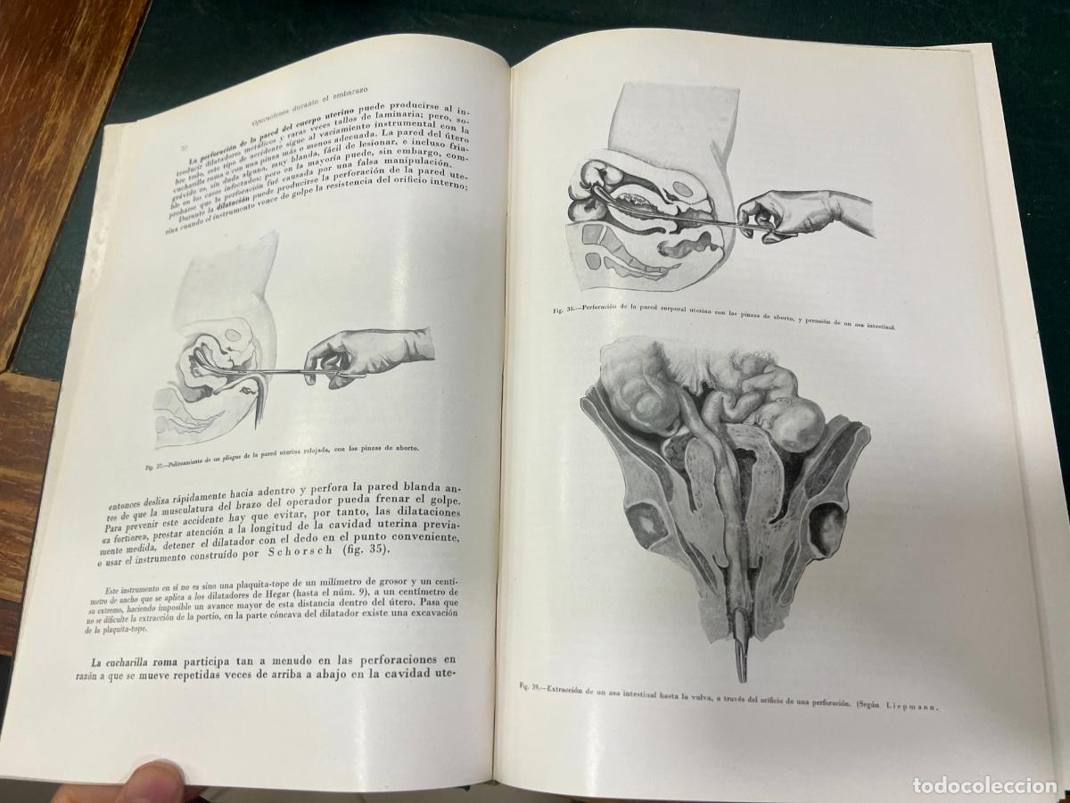 Libros de segunda mano: LIBRO TRATADO DE OBSTETRICIA OPERATORIA - A&Ntilde;O 1955 - Foto 6