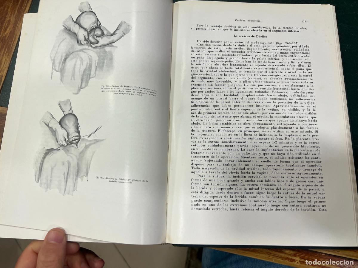 Libros de segunda mano: LIBRO TRATADO DE OBSTETRICIA OPERATORIA - A&Ntilde;O 1955 - Foto 10