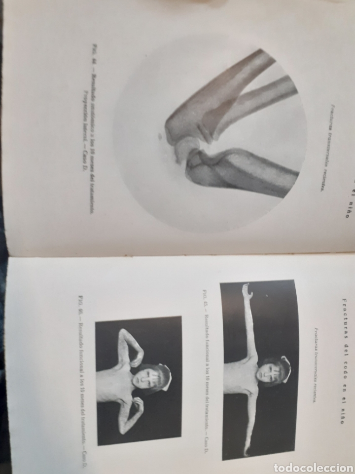 Libros: FRACTURAS DEL CODO EN EL NI&Ntilde;O - LOPEZ DURAN,Adolfo - Foto 5