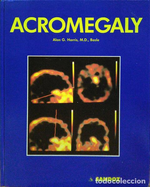 Libros: HARRIS. (Alan G.) - ACROMEGALY. - Foto 1