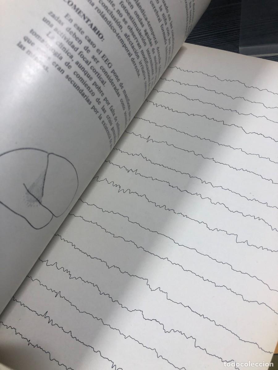 Libros: Atlas elemental de EEG en epilepsias Secci&oacute;n Cient&iacute;fica &rdquo;Roche&rdquo; - Foto 2