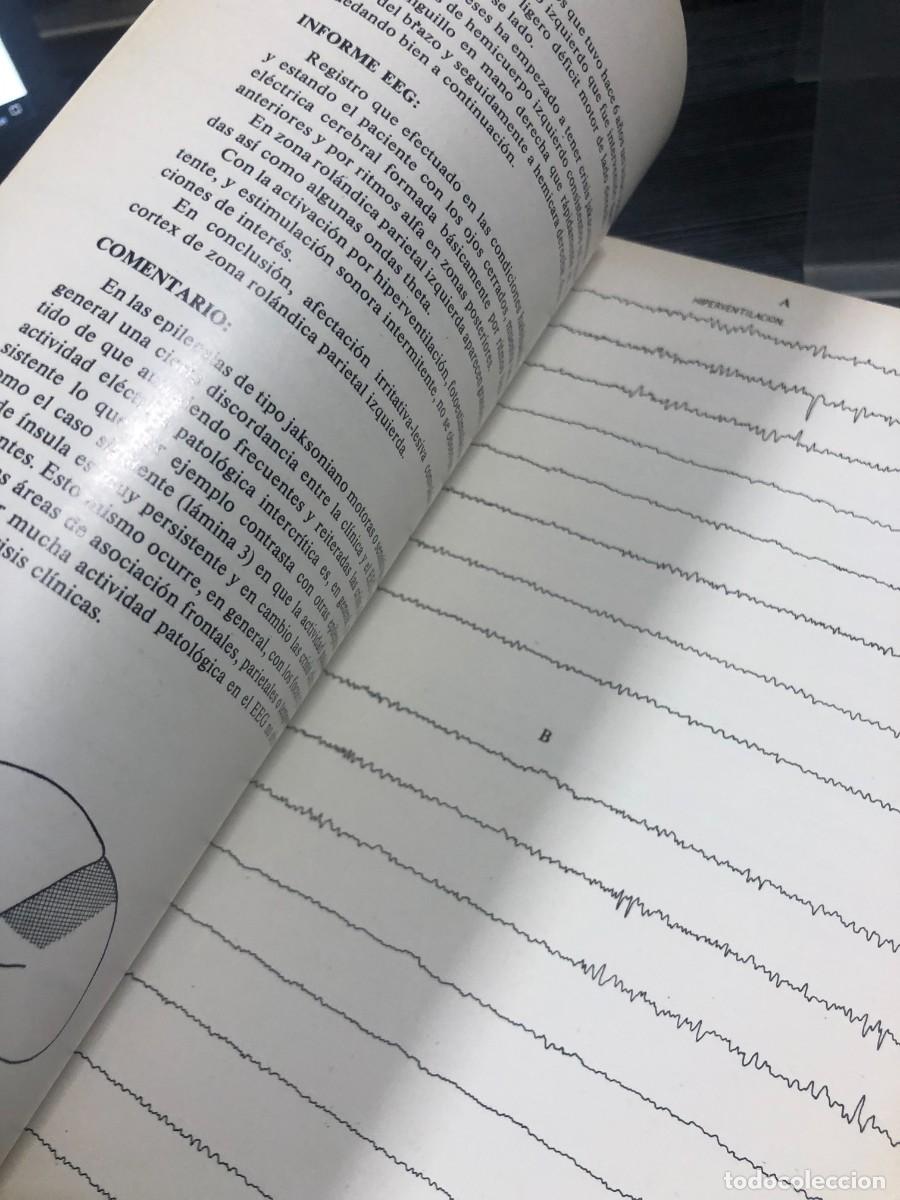Libros: Atlas elemental de EEG en epilepsias Secci&oacute;n Cient&iacute;fica &rdquo;Roche&rdquo; - Foto 4